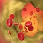 如何知道血管里有没有斑块？逆转斑块的关键是控制胆固醇！-云欣小站