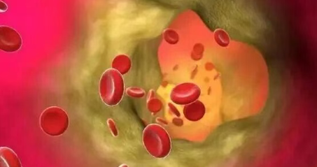 如何知道血管里有没有斑块？逆转斑块的关键是控制胆固醇！-云欣小站